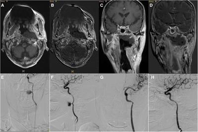 Efficacy analysis of endovascular treatment for ruptured internal carotid artery pseudoaneurysm hemorrhage in patients with nasopharyngeal carcinoma after radiotherapy
